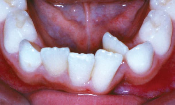 Crowding Gather Orthodontics in Holly Springs, NC