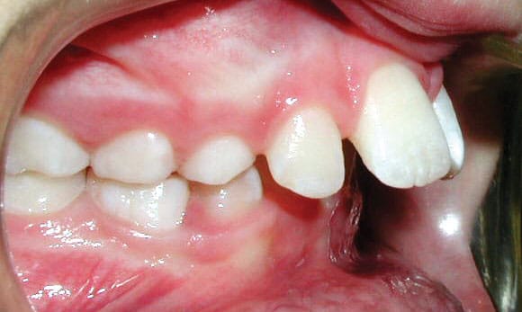 Protrusion Gather Orthodontics in Holly Springs, NC