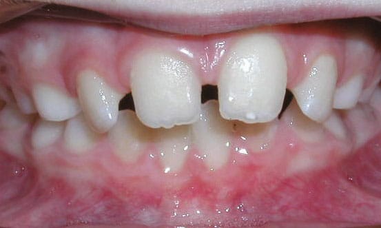 Spacing Gather Orthodontics in Holly Springs, NC