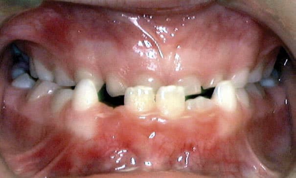 Underbite Gather Orthodontics in Holly Springs, NC