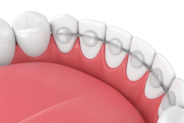 Fixed Retainers Gather Orthodontics in Holly Springs, NC